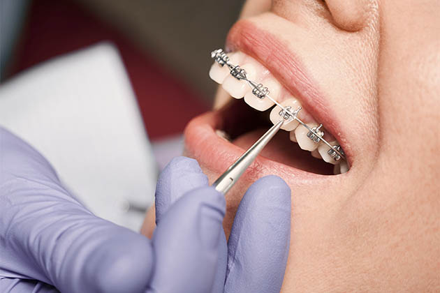 Vemos um cuidado ortodóntico. Descubra qual a frequência para uma consulta odontológica!