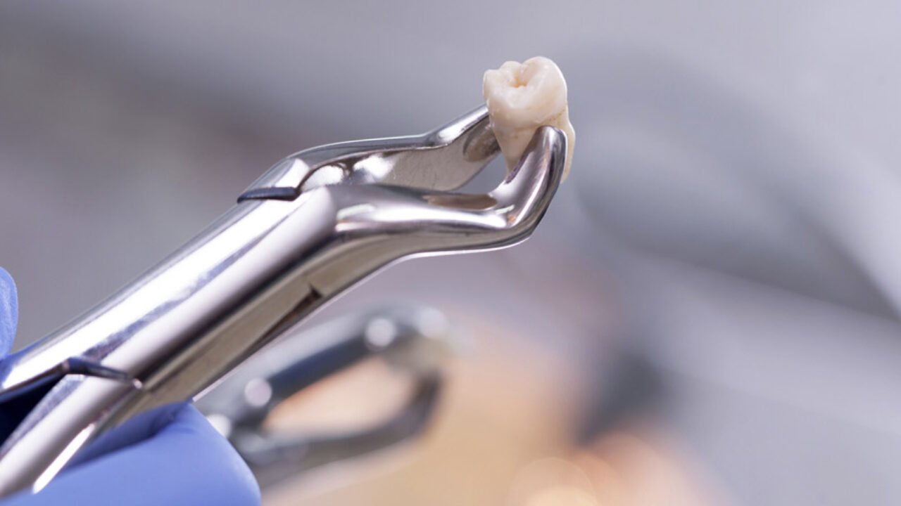 Extração do dente: quais os cuidados de Pós-exodontia?