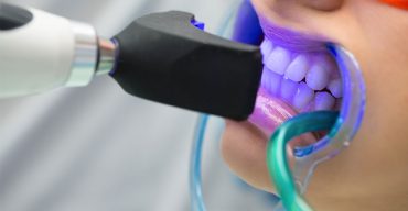 8 mitos do clareamento dental