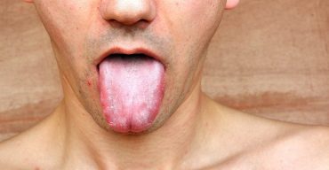 Homem mostrando sua língua branca