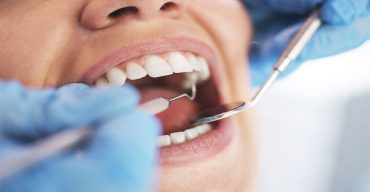 Profilaxia dental: o que é, quais são as etapas e seus benefícios