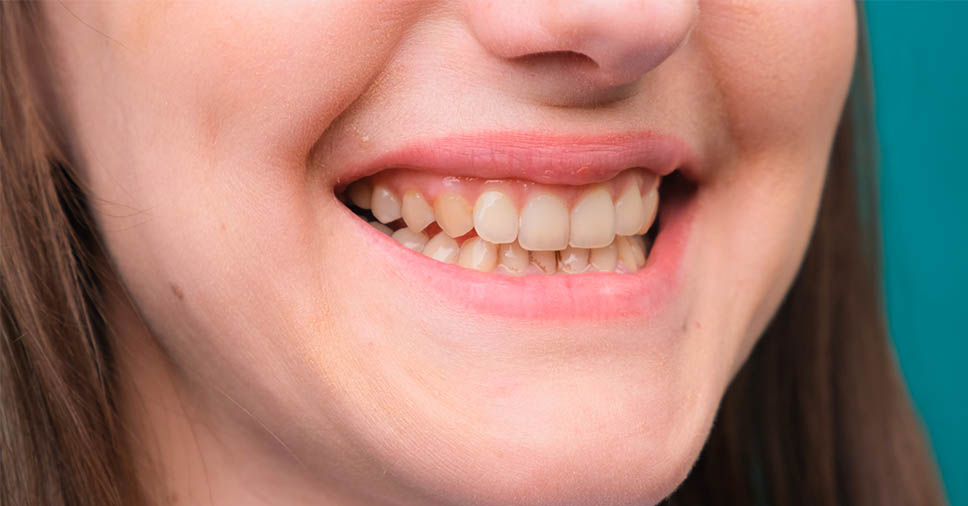 Vemos dentes amarelados. Saiba quais são as causas!